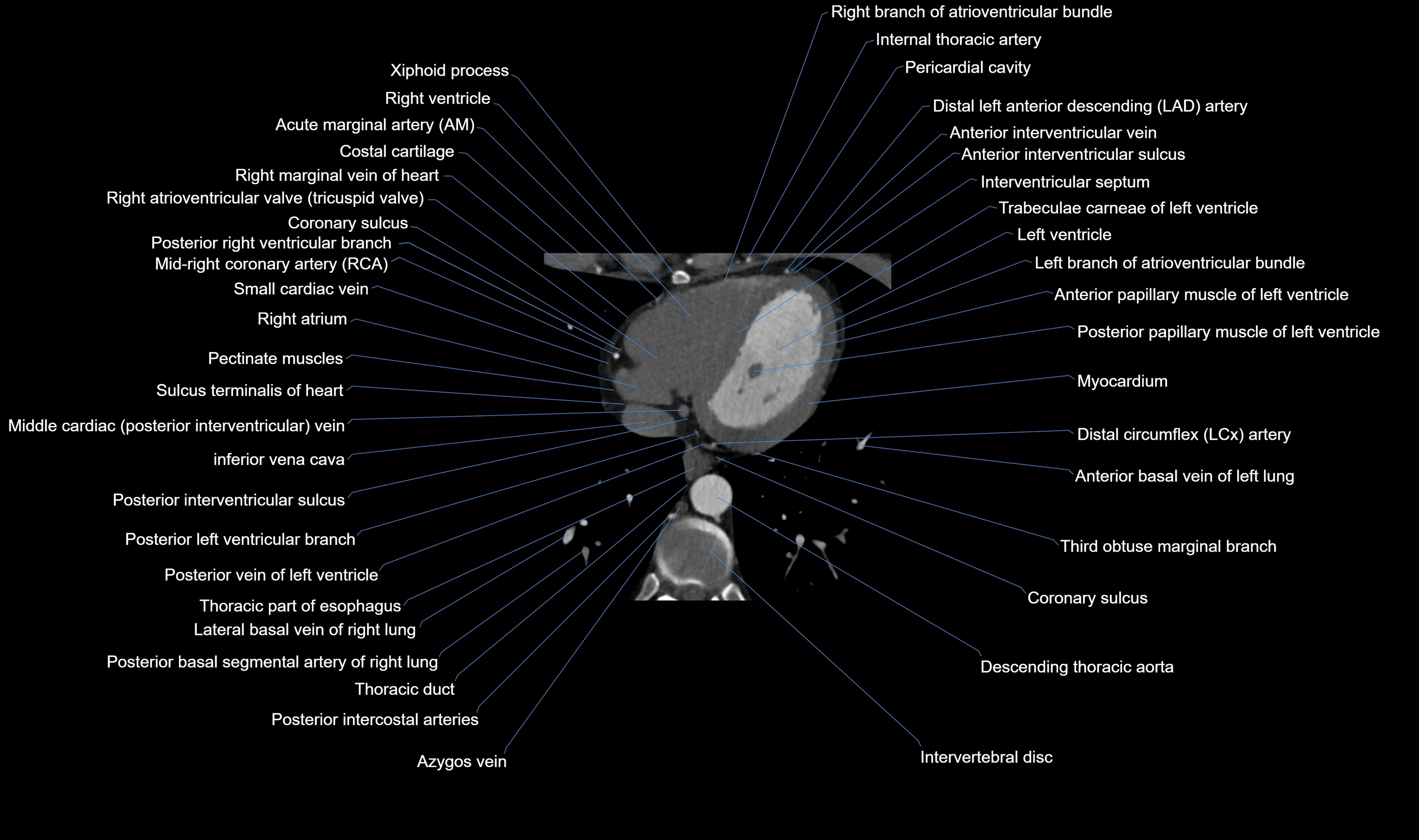 CT heart (coronary angiogram) axial view cross sectional anatomy labelled radiology image-00053.webp